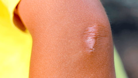 A person with a bright yellow shirt in the background showing their elbow with scar tissue showing from a recently healed injury. 