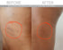 SCULPT Cellulite Cupping Set